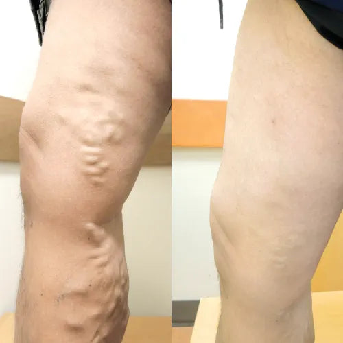Crema Natural para Vena Varices - 60g